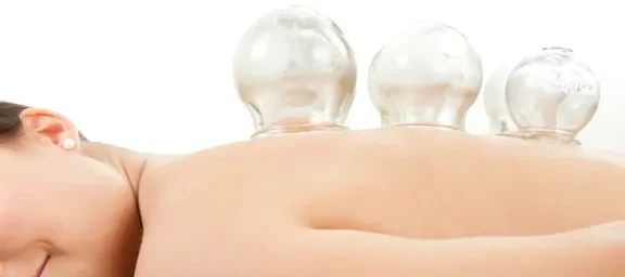 Alternative Therapy: Cupping