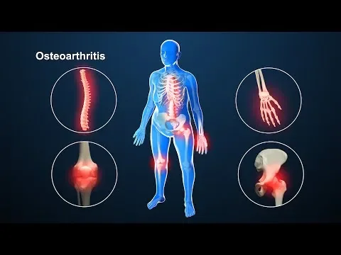 What is Osteoarthritis? Why is My Joint in Pain?